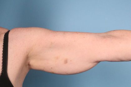 Arm Lift Before & After Image