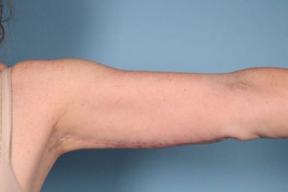 Arm Lift Before & After Image