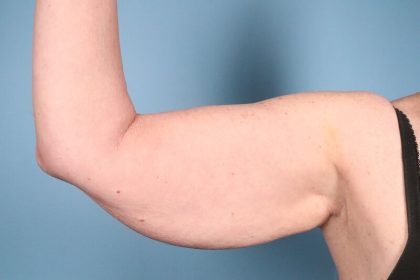 Arm Lift Before & After Image