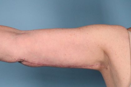 Arm Lift Before & After Image