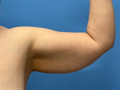 Arm Lift Before & After Image