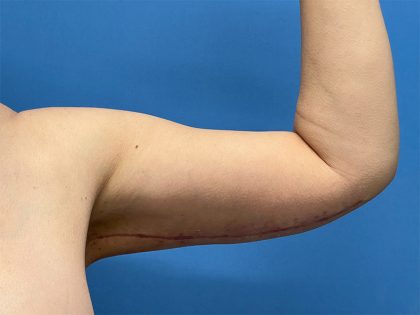 Arm Lift Before & After Image