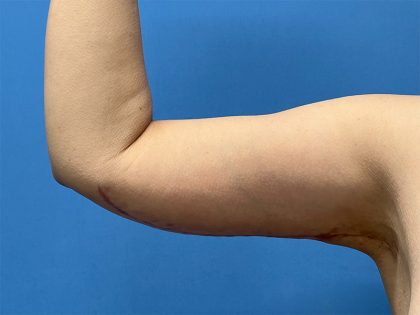 Arm Lift Before & After Image