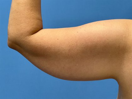 Arm Lift Before & After Image