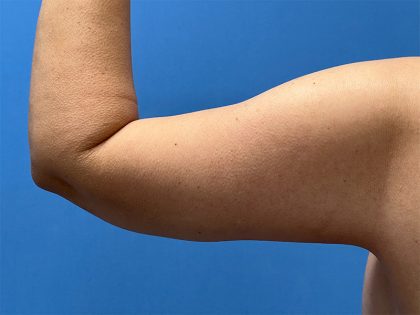 Arm Lift Before & After Image