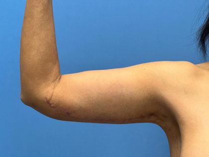 Arm Lift Before & After Image