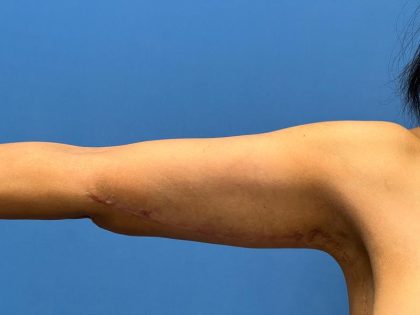 Arm Lift Before & After Image