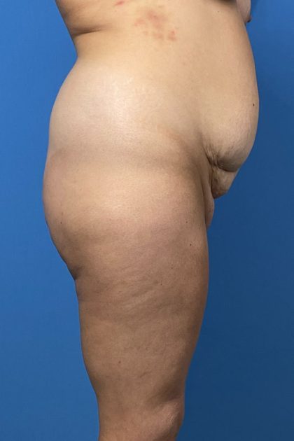 Brazilian Butt Lift Before & After Image