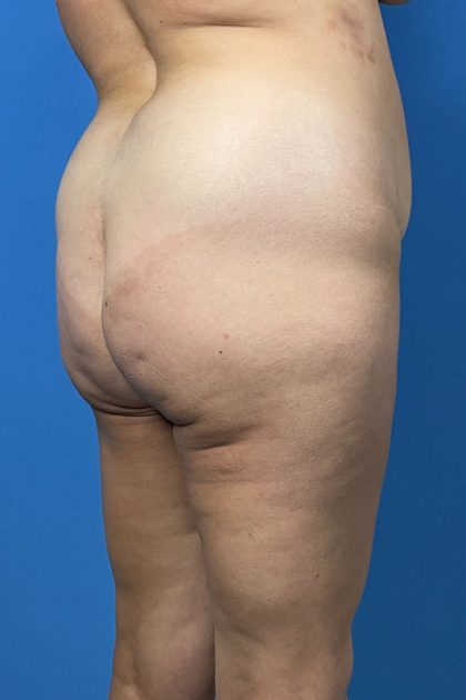 Brazilian Butt Lift Before & After Image