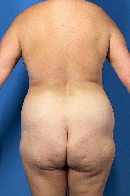 Brazilian Butt Lift Before & After Image