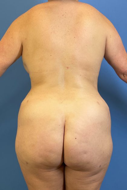 Brazilian Butt Lift Before & After Image