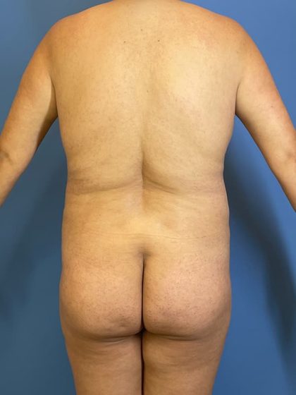 Brazilian Butt Lift Before & After Image