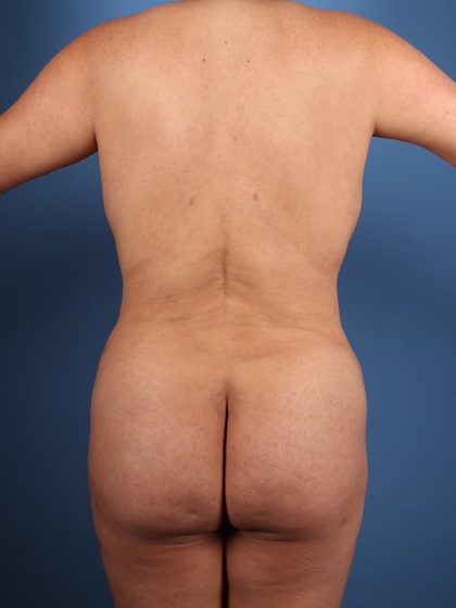 Brazilian Butt Lift Before & After Image