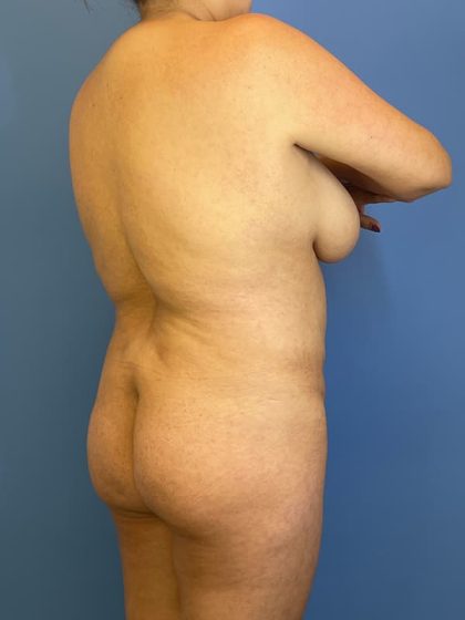 Brazilian Butt Lift Before & After Image