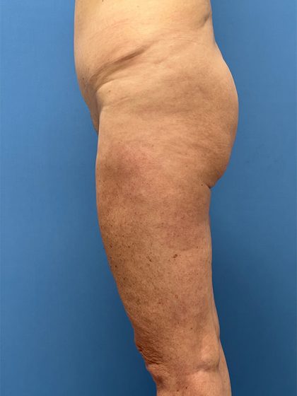 Brazilian Butt Lift Before & After Image