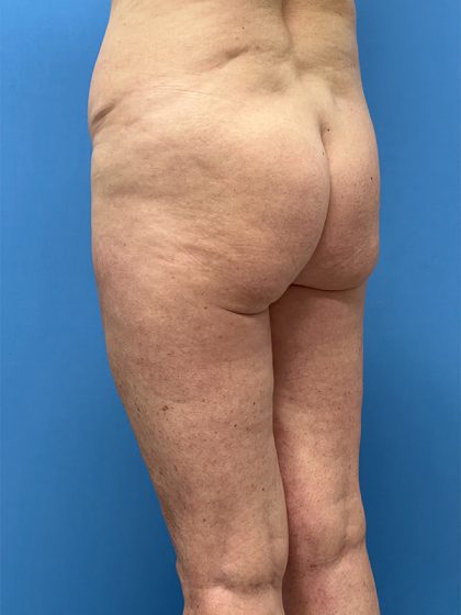 Brazilian Butt Lift Before & After Image