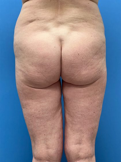 Brazilian Butt Lift Before & After Image