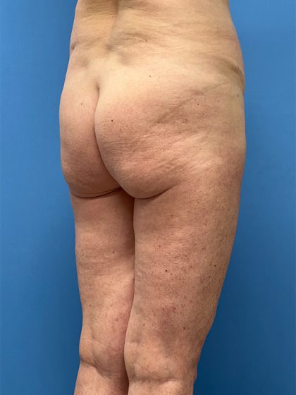 Brazilian Butt Lift Before & After Image