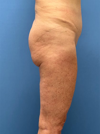 Brazilian Butt Lift Before & After Image