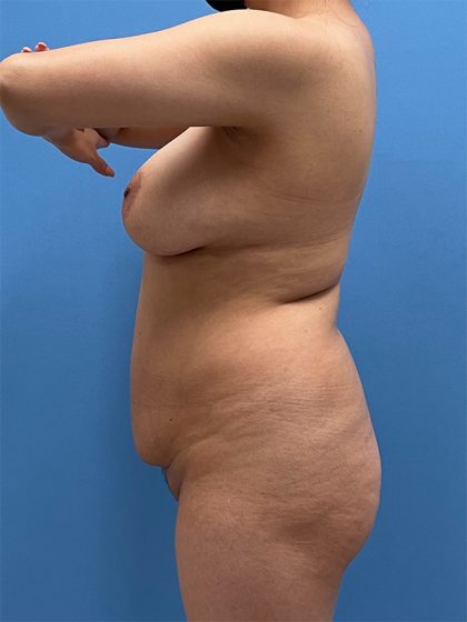 Brazilian Butt Lift Before & After Image