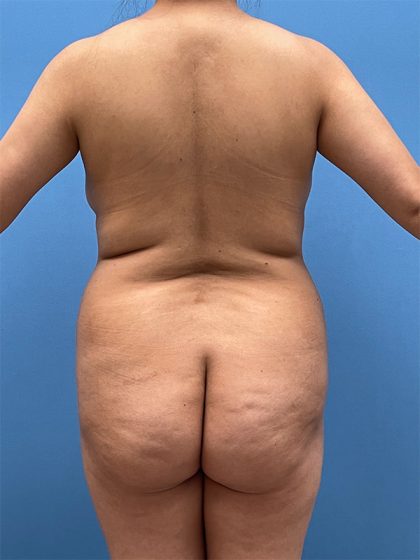 Brazilian Butt Lift Before & After Image