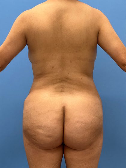 Brazilian Butt Lift Before & After Image