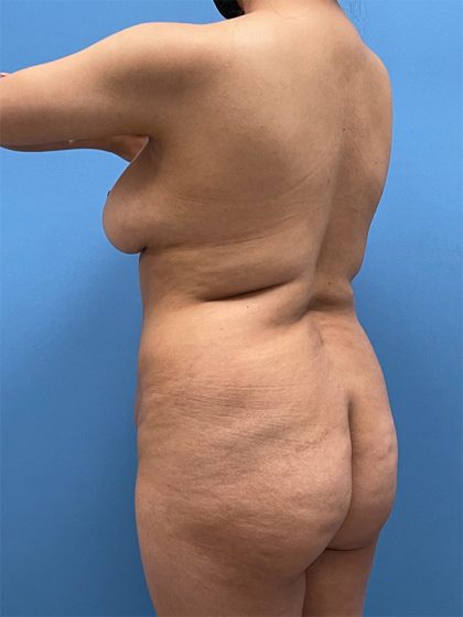 Brazilian Butt Lift Before & After Image