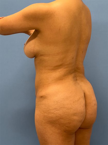 Brazilian Butt Lift Before & After Image