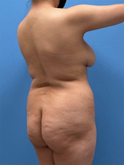 Brazilian Butt Lift Before & After Image