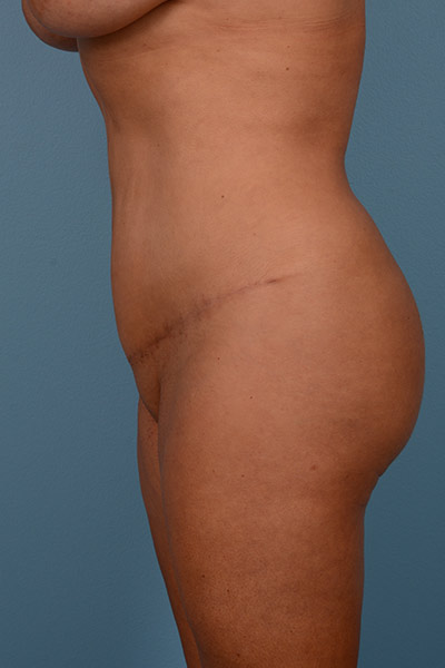 Brazilian Butt Lift Before & After Image