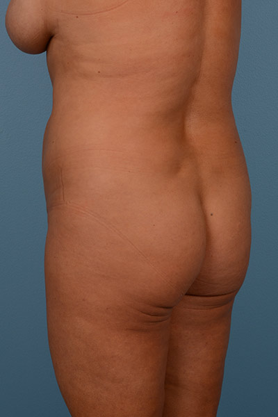 Brazilian Butt Lift Before & After Image