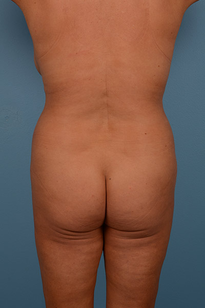 Brazilian Butt Lift Before & After Image