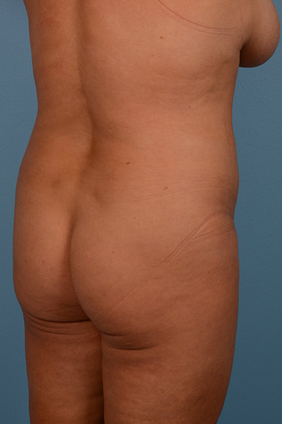 Brazilian Butt Lift Before & After Image