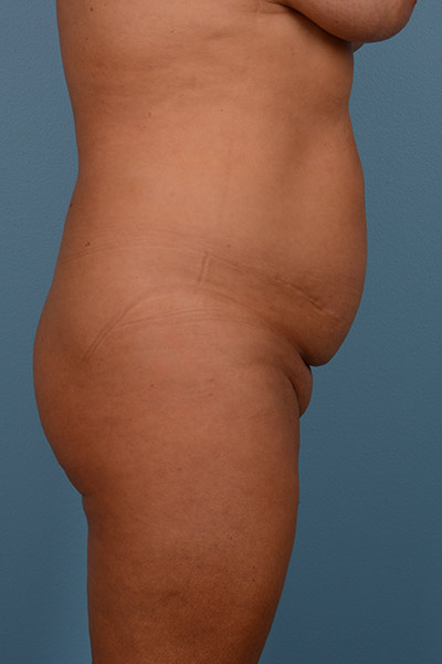 Brazilian Butt Lift Before & After Image