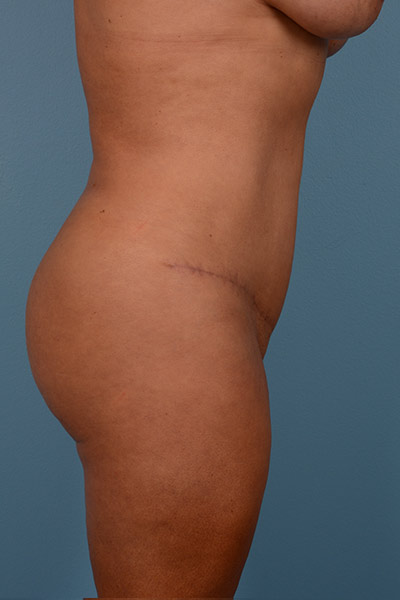 Brazilian Butt Lift Before & After Image