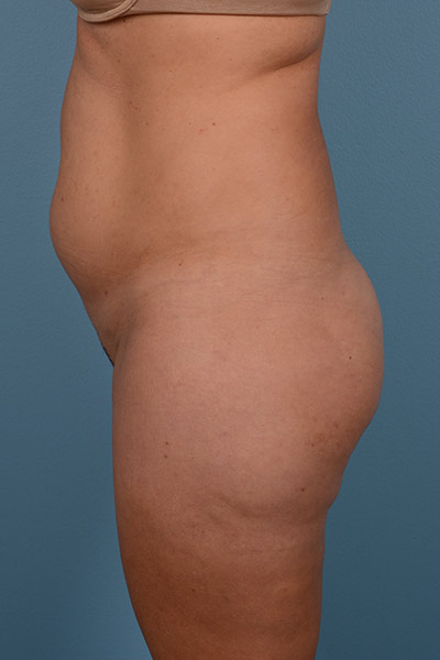 Brazilian Butt Lift Before & After Image