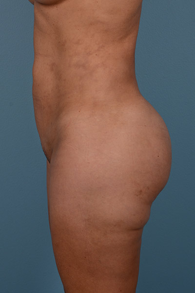 Brazilian Butt Lift Before & After Image