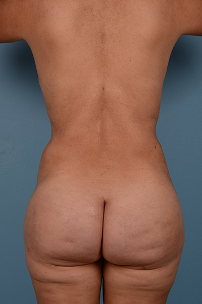 Brazilian Butt Lift Before & After Image