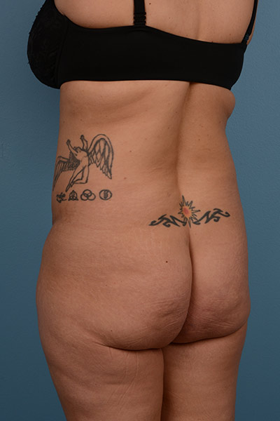 Brazilian Butt Lift Before & After Image