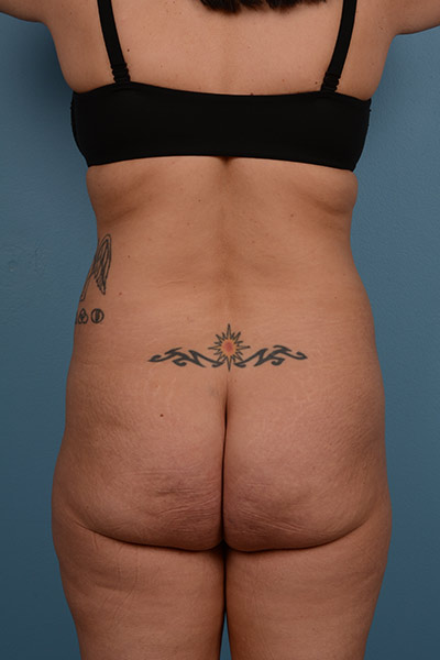 Brazilian Butt Lift Before & After Image