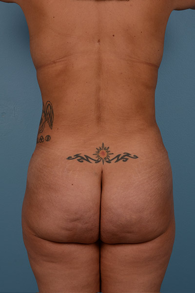 Brazilian Butt Lift Before & After Image