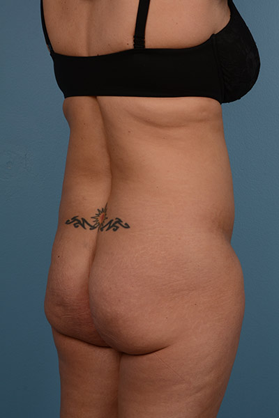 Brazilian Butt Lift Before & After Image