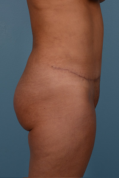 Brazilian Butt Lift Before & After Image