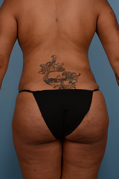 Brazilian Butt Lift Before & After Image