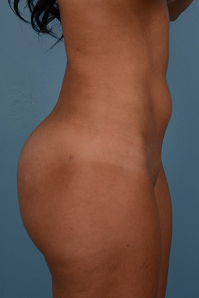 Brazilian Butt Lift Before & After Image