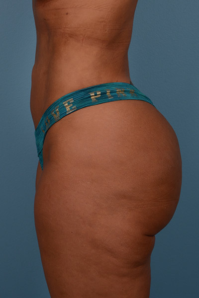 Brazilian Butt Lift Before & After Image