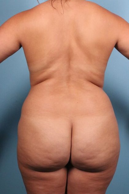 Brazilian Butt Lift Before & After Image