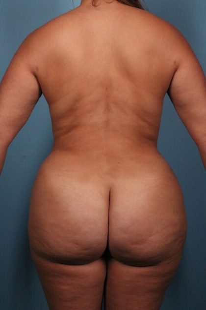 Brazilian Butt Lift Before & After Image