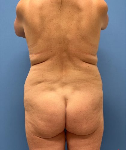 Brazilian Butt Lift Before & After Image