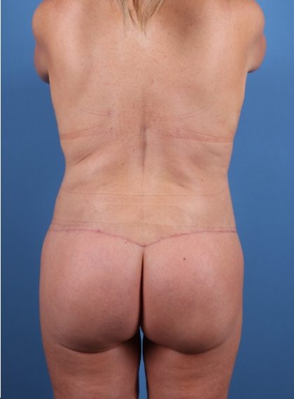 Brazilian Butt Lift Before & After Image